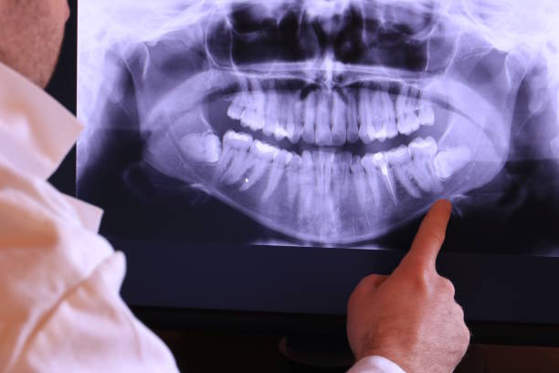 Best Emergency Wisdom Tooth Extraction in Union, OH