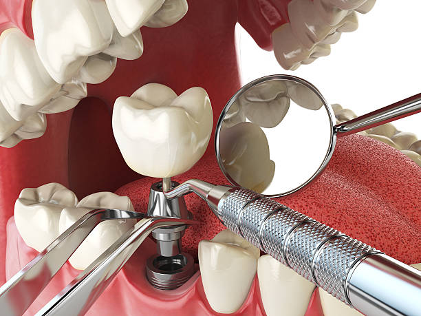 Best Broken or Chipped Tooth Repair in Union, OH